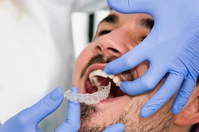 man having his clear aligners fitted