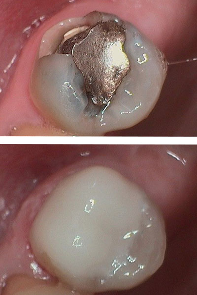 same-day crown replaces metal filling to help a patient's teeth be more uniform in color